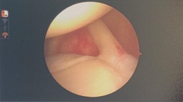 arthroscopic view of my shoulder joint